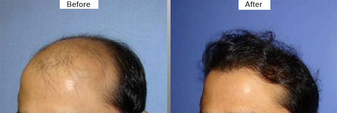 Best Hair Loss Treatment Cost Hair Fall Doctor in Mumbai India